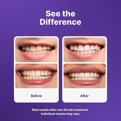 Whitening Strips